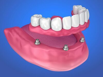 dentures, including implant-supported dentures