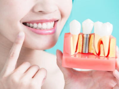 Dental Implant