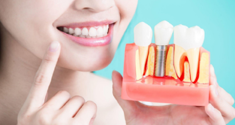 Effective Habits for Dental Implant Maintenance Dental Implant